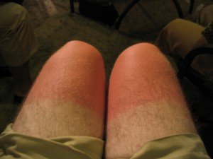 sunburned knees